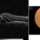 Chronic Central Serous Chorioretinopathy Chronic Central Serous Chorioretinopathy